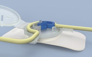 Read more about the article Cathetrix enters Canadian urinary care market, partners with K77 to explore market opportunities